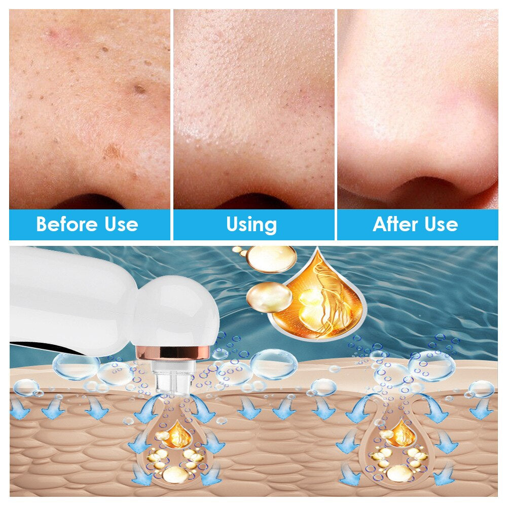 Rebolet | Hydrodermabrasion Mitesserentferner