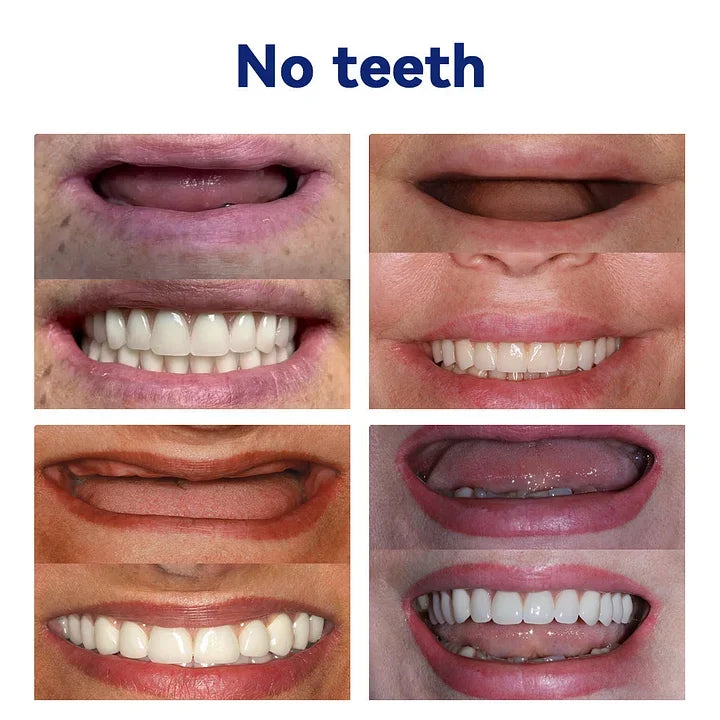 Rebolet | SmileFitPro™ – Lösung der neuen Generation: Flexible Vollprothese
